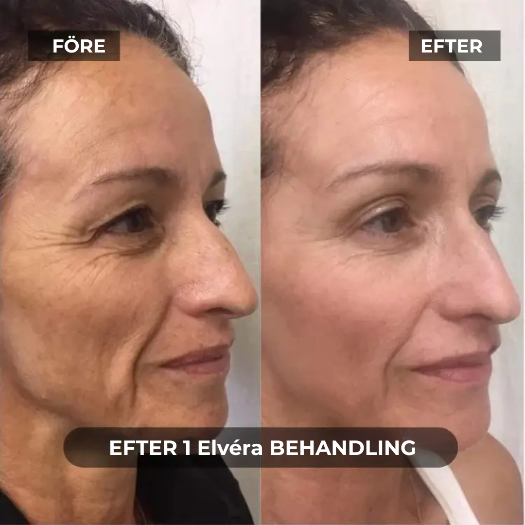Elvéra® | Glöd Som Aldrig Förr – Den Banbrytande Anti-Aging Genombrottet för Hemmet är Här!