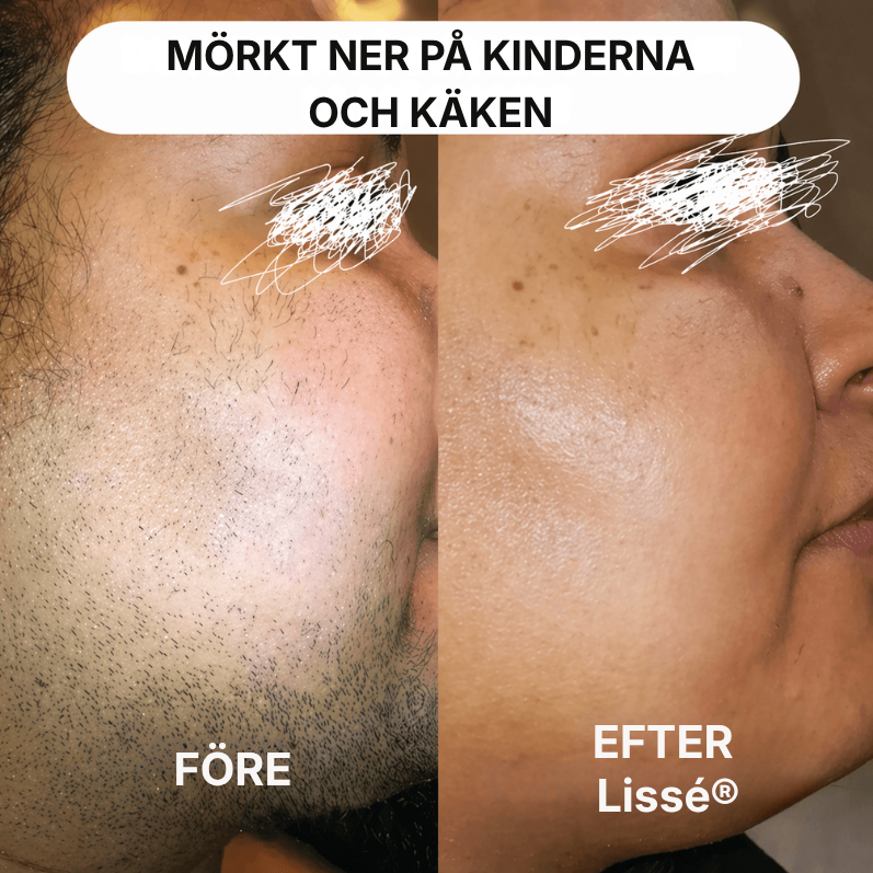 Lissé® | 2-i-1-hårborttagare för ansiktet