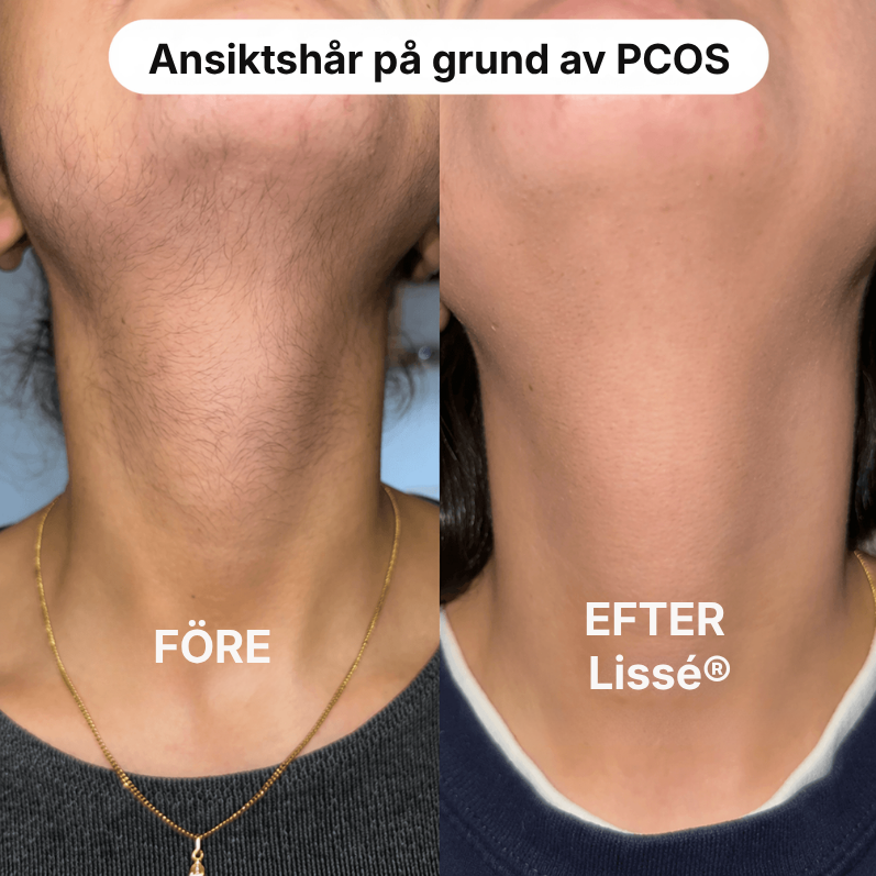 Lissé® | 2-i-1-hårborttagare för ansiktet