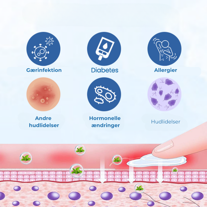 VerruRo® Vårtlindringskräm | Bekämpa vårtor vid roten – Skonsam, snabbtverkande och kliniskt dokumenterad