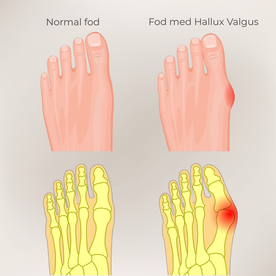 FlexiToe® | Skonsam tåjustering för daglig lindring
