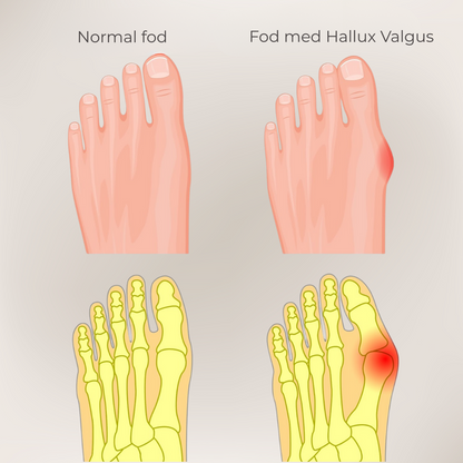 FlexiToe® | Skonsam tåjustering för daglig lindring