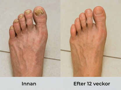 Nailura® | Nagelvårdspenna