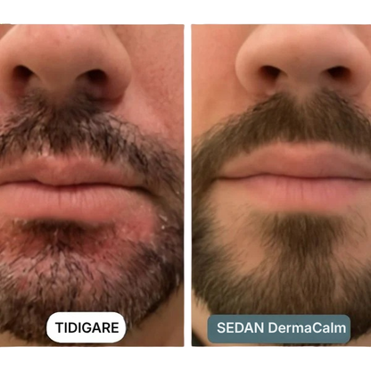DermaCalm® | Kräm mot seborroisk dermatit, hårbottenbehandling mot psoriasis, torr hårbotten och mjäll, klådstillande kräm för lindrande effekt