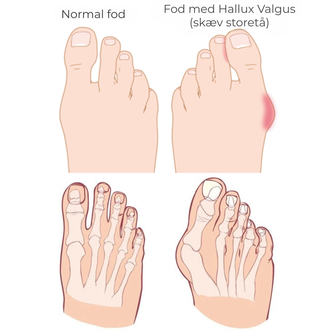 FlexiToe® | Skonsam tåjustering för daglig lindring