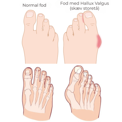 FlexiToe® | Skonsam tåjustering för daglig lindring