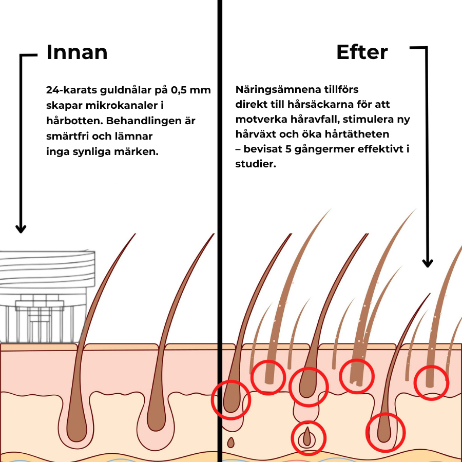 Folira® | Håråterväxtsystem – 1 infusionssystem, 4 serum