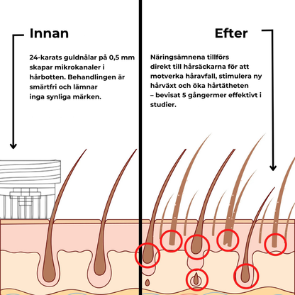 Folira® | Håråterväxtsystem – 1 infusionssystem, 4 serum