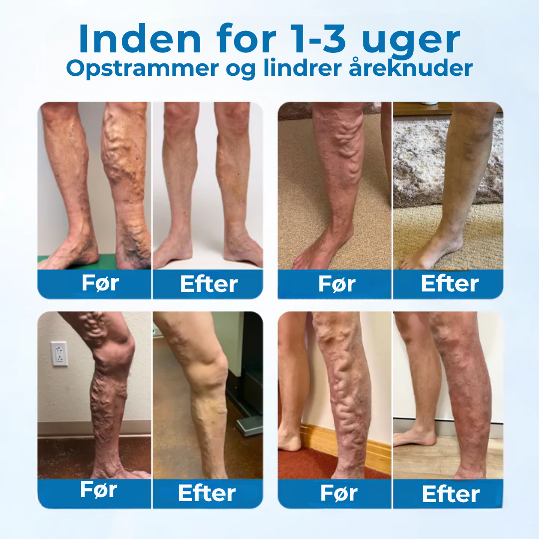 CircuClear® | Ta kontrollen över dina ben tillbaka – synlig lindring på bara 1 vecka