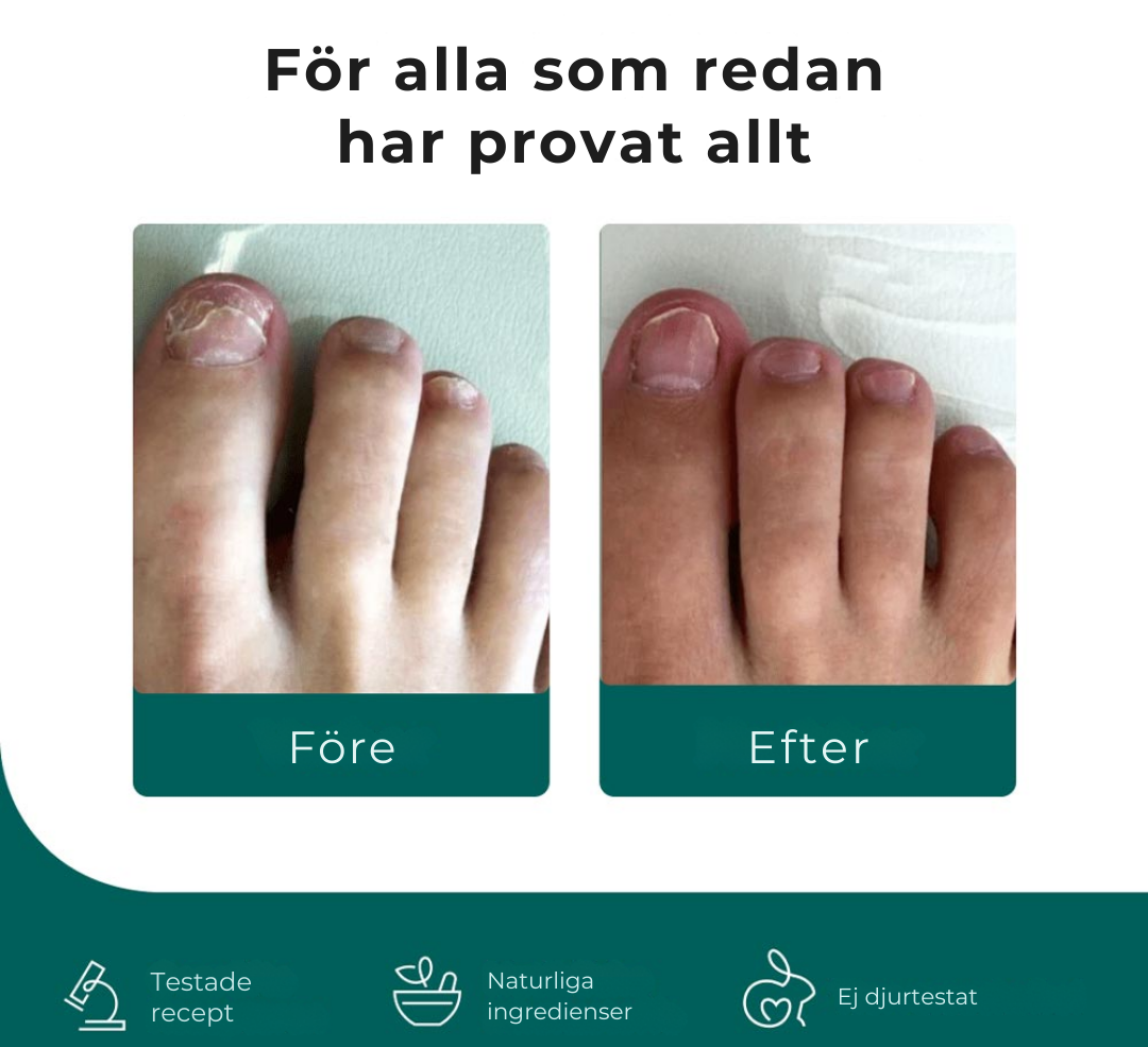 NagelFri® | Sluta gömma dina naglar – bli av med nagelsvamp från roten på bara 12 veckor!