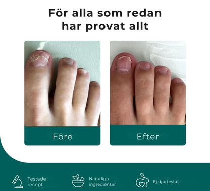 NagelFri® | Sluta gömma dina naglar – bli av med nagelsvamp från roten på bara 12 veckor!
