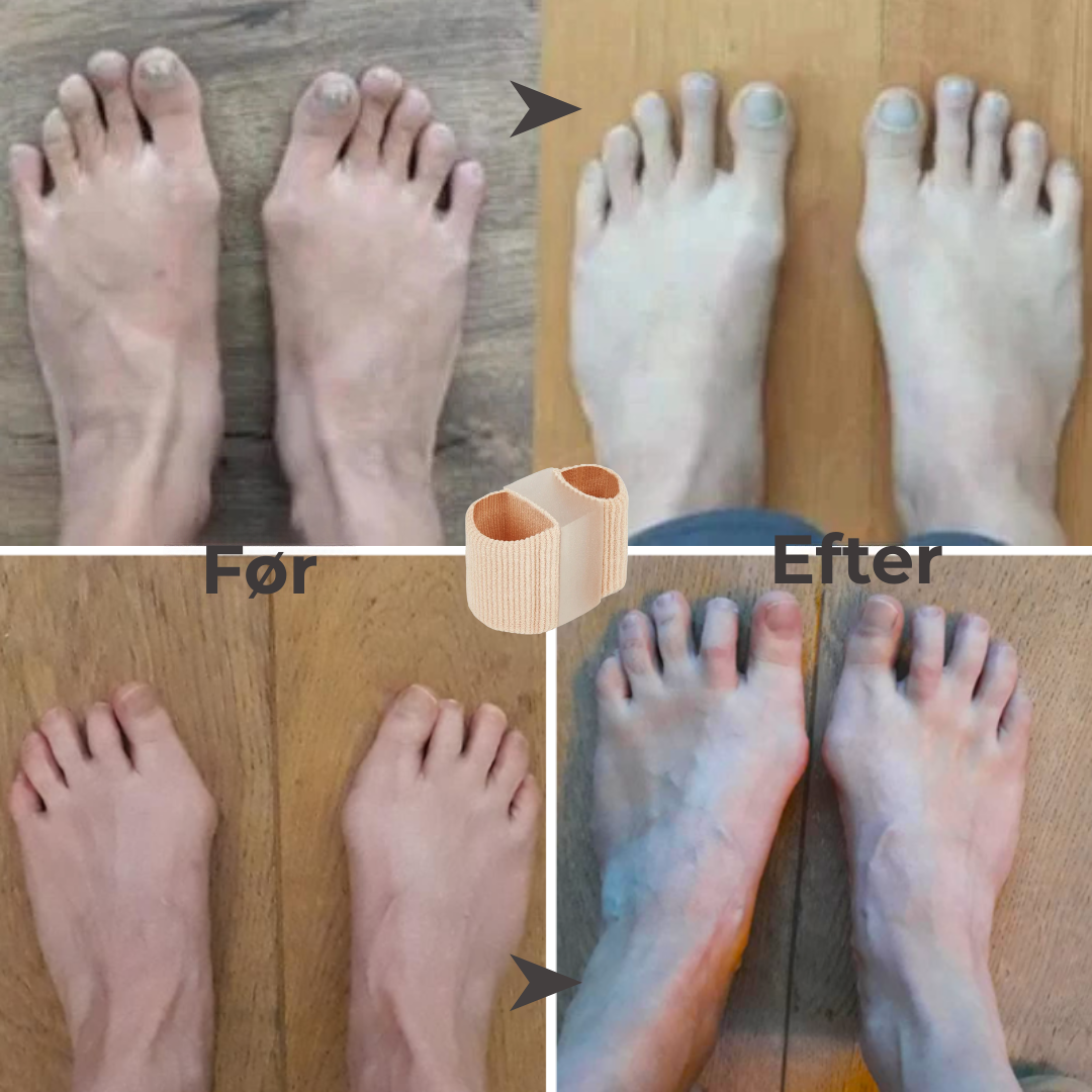 FlexiToe® | Skonsam tåjustering för daglig lindring