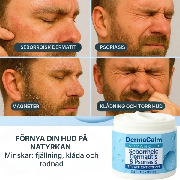 DermaCalm® | Kräm mot seborroisk dermatit, hårbottenbehandling mot psoriasis, torr hårbotten och mjäll, klådstillande kräm för lindrande effekt