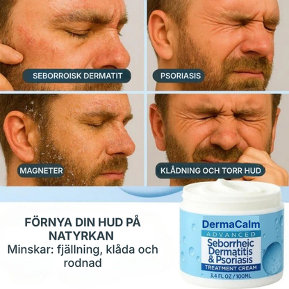 DermaCalm® | Kräm mot seborroisk dermatit, hårbottenbehandling mot psoriasis, torr hårbotten och mjäll, klådstillande kräm för lindrande effekt
