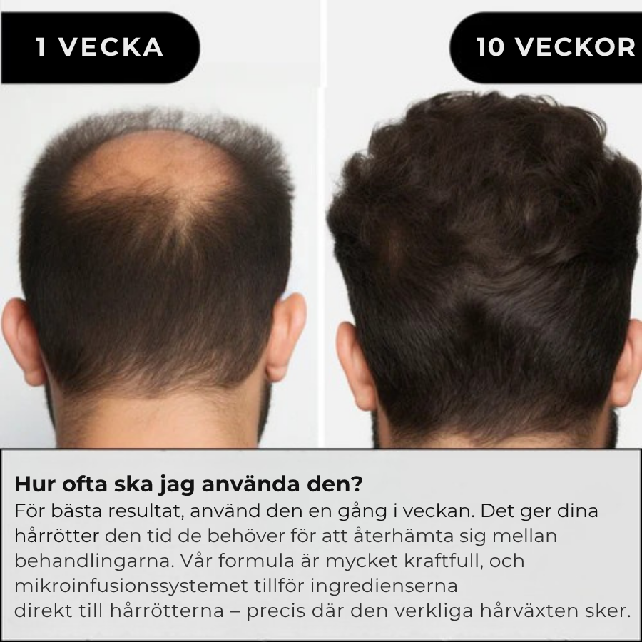 Folira® | Håråterväxtsystem – 1 infusionssystem, 4 serum