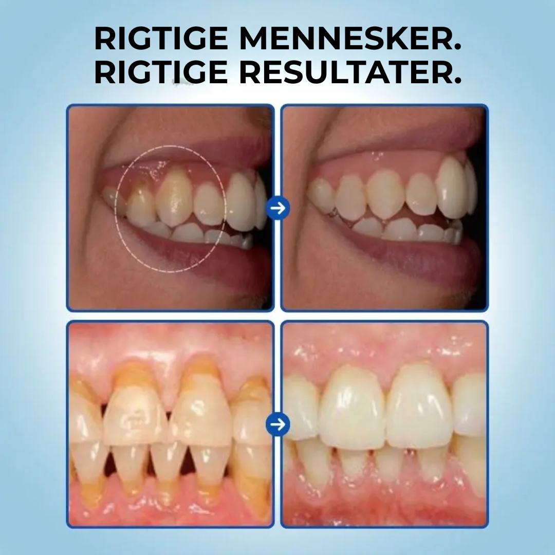 TandRo® | Stoppa tandköttsretraktion naturligt, smärtfritt och på bara 3 dagar!