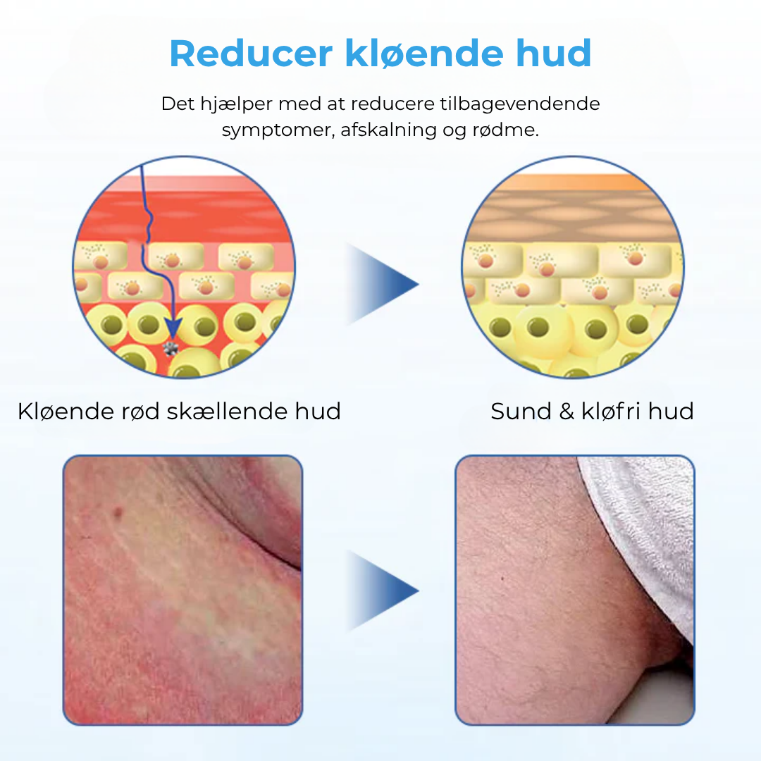 VerruRo® Vårtlindringskräm | Bekämpa vårtor vid roten – Skonsam, snabbtverkande och kliniskt dokumenterad