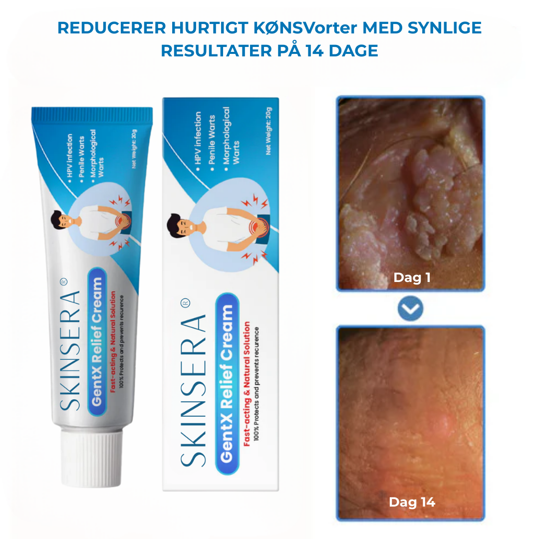Skinsera® HPV Vårtor Lättnad Kräm
