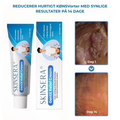 Skinsera® HPV Vårtor Lättnad Kräm