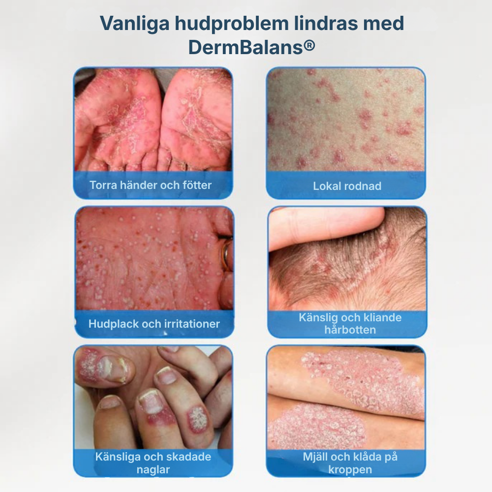 DermBalans® | Bekämpa mjäll, klåda och rodnad vid källan