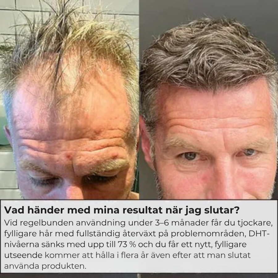 Folira® | Håråterväxtsystem – 1 infusionssystem, 4 serum