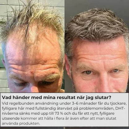 Folira® | Håråterväxtsystem – 1 infusionssystem, 4 serum