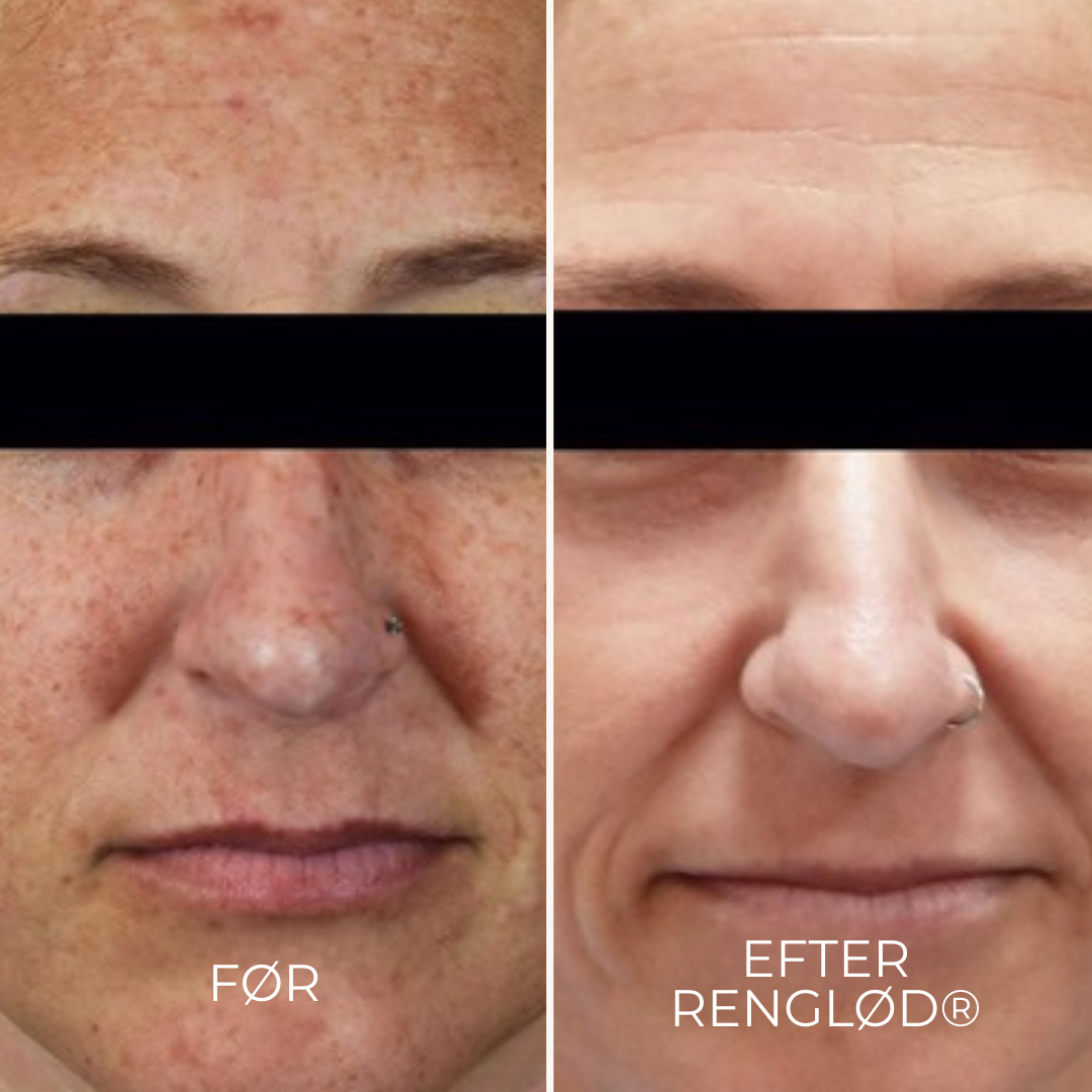 RenGlöd® | Anti-Mörkfläck Creme