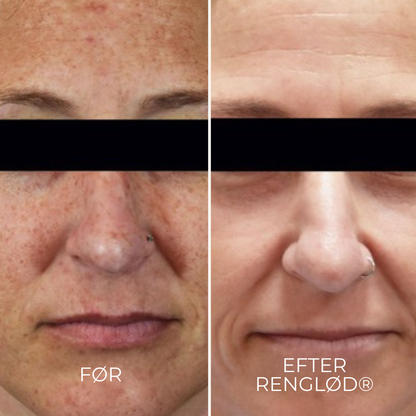 RenGlöd® | Anti-Mörkfläck Creme