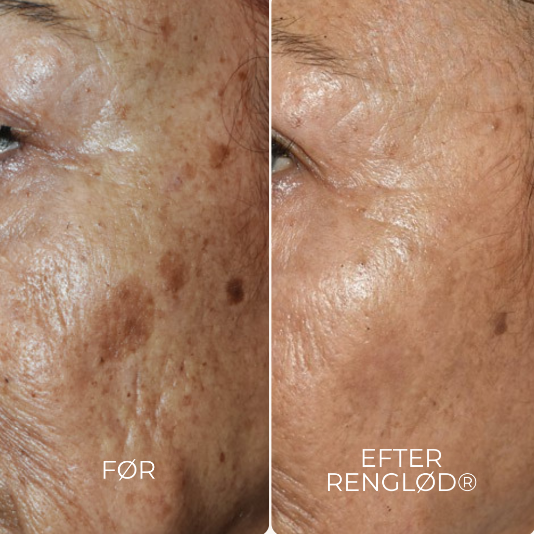 RenGlöd® | Anti-Mörkfläck Creme