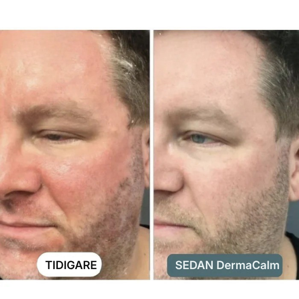 DermaCalm® | Kräm mot seborroisk dermatit, hårbottenbehandling mot psoriasis, torr hårbotten och mjäll, klådstillande kräm för lindrande effekt