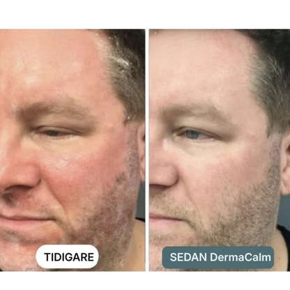 DermaCalm® | Kräm mot seborroisk dermatit, hårbottenbehandling mot psoriasis, torr hårbotten och mjäll, klådstillande kräm för lindrande effekt