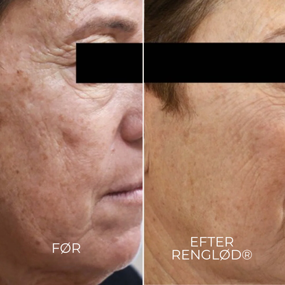 RenGlöd® | Anti-Mörkfläck Creme