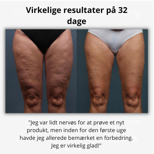 Glattéa® | 3-Stegs Anti-Cellulite System