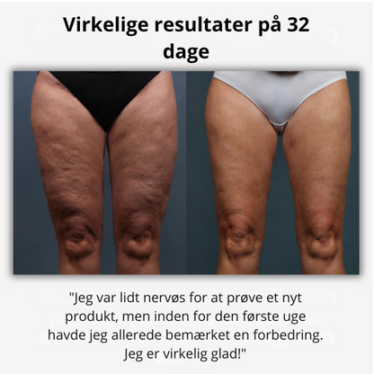 Glattéa® | 3-Stegs Anti-Cellulite System