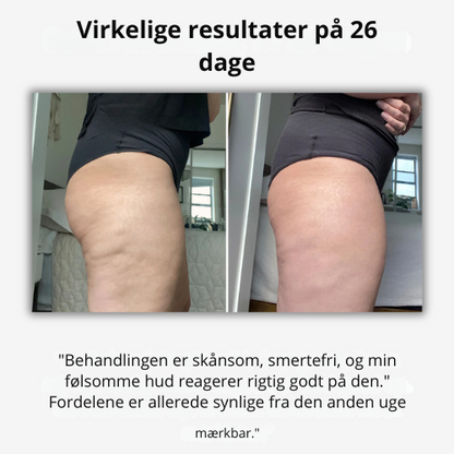 Glattéa® | 3-Stegs Anti-Cellulite System