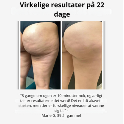 Glattéa® | 3-Stegs Anti-Cellulite System