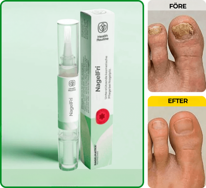 NagelFri® | Sluta gömma dina naglar – bli av med nagelsvamp från roten på bara 12 veckor!