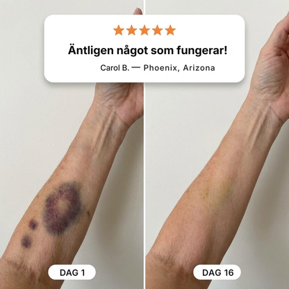 Brusia® | Äntligen en kräm som får blåmärken på känslig hud att blekna