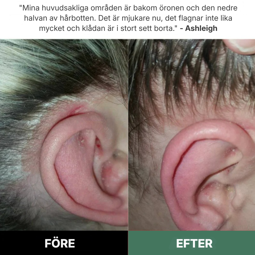 Rootique® | Ett nytt sätt att lindra klåda och fjällande hårbotten – utan steroider