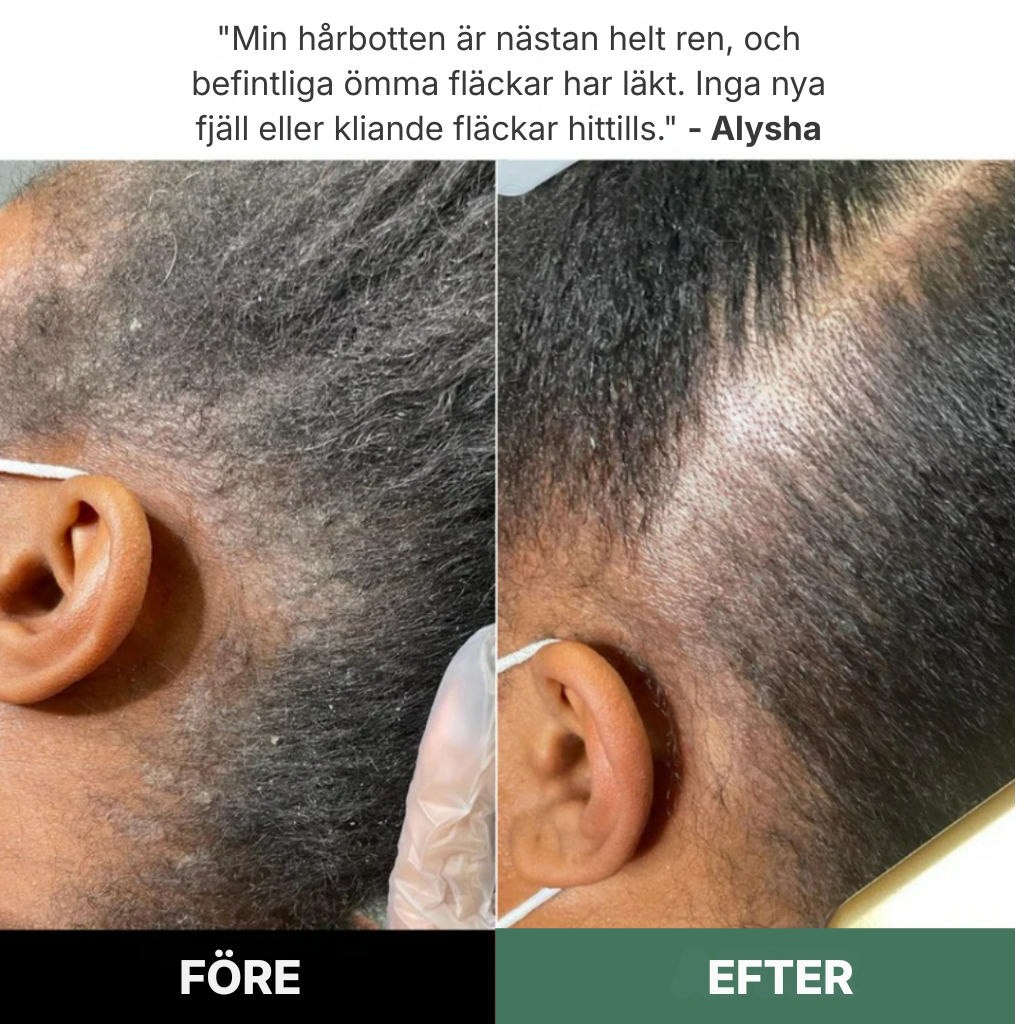 Rootique® | Ett nytt sätt att lindra klåda och fjällande hårbotten – utan steroider