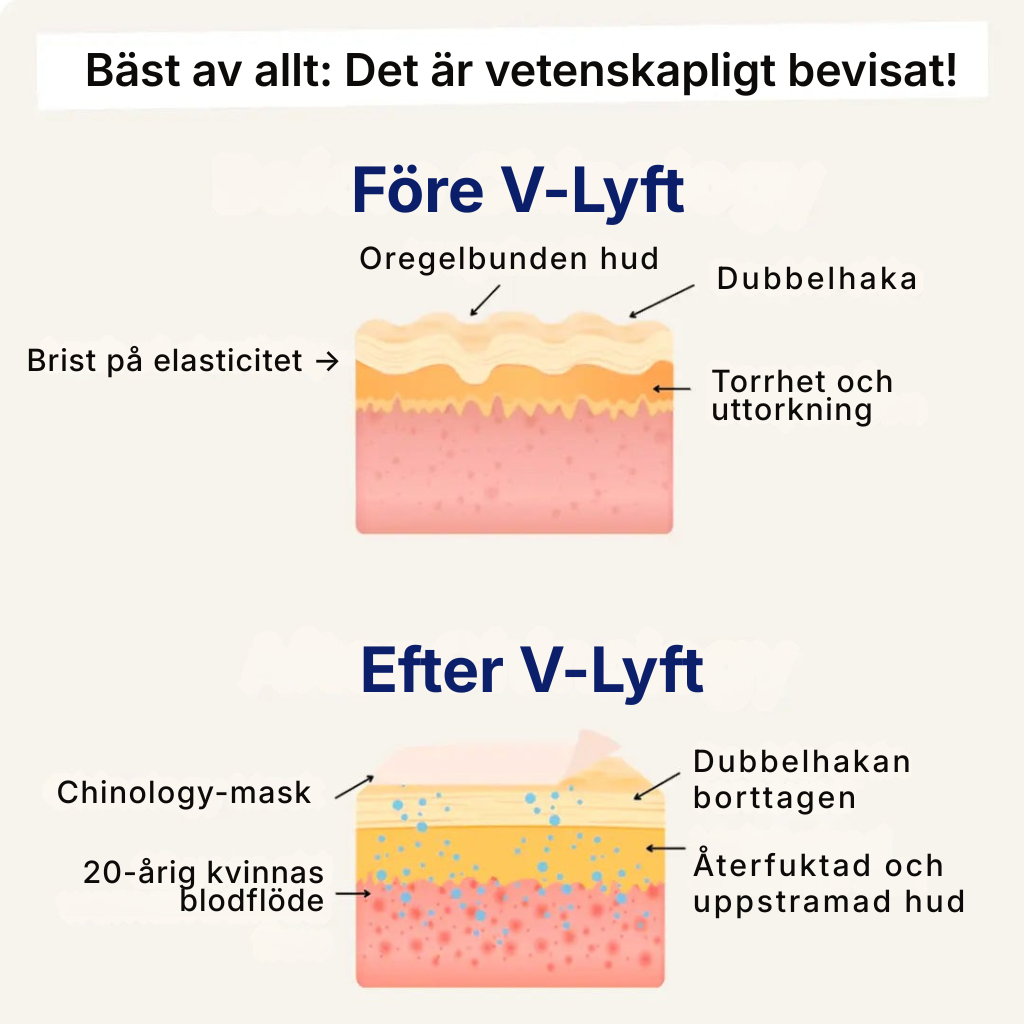 V-Lyft® | Känn dig självsäker igen med en naturligt lyft käklinje på 3 veckor