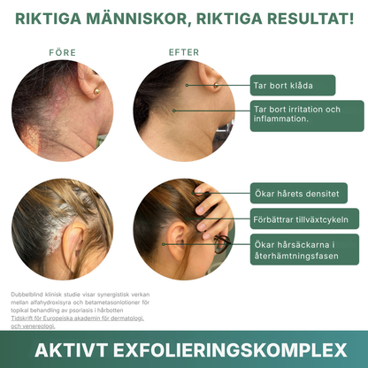 Rootique® | Ett nytt sätt att lindra klåda och fjällande hårbotten – utan steroider