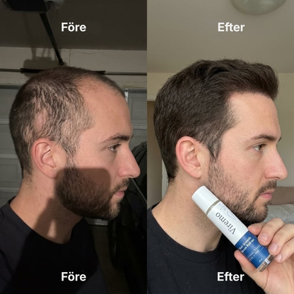 Viremo® Roll-on-serum för hårväxt