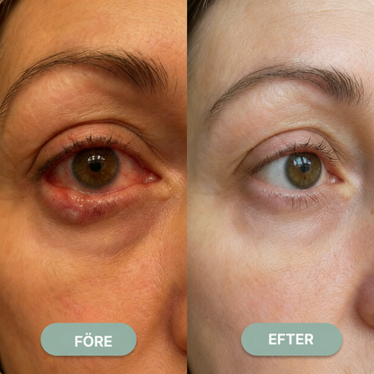 Oculiva® | Terapeutisk ångapparat – Verklig lindring vid torrhet, sveda, irritation, ögoninflammation och svullnader under ögonen