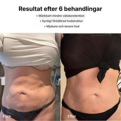 CelluSculpt® | Massageapparat mot celluliter