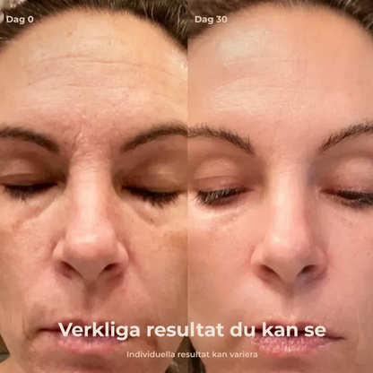 Lumira® | Lift, återfuktning och reducering av rynkor